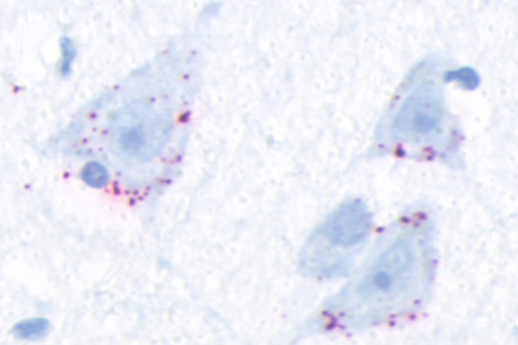 cells viewed under a microscope, showing stained clumps of TDP-43 protein
